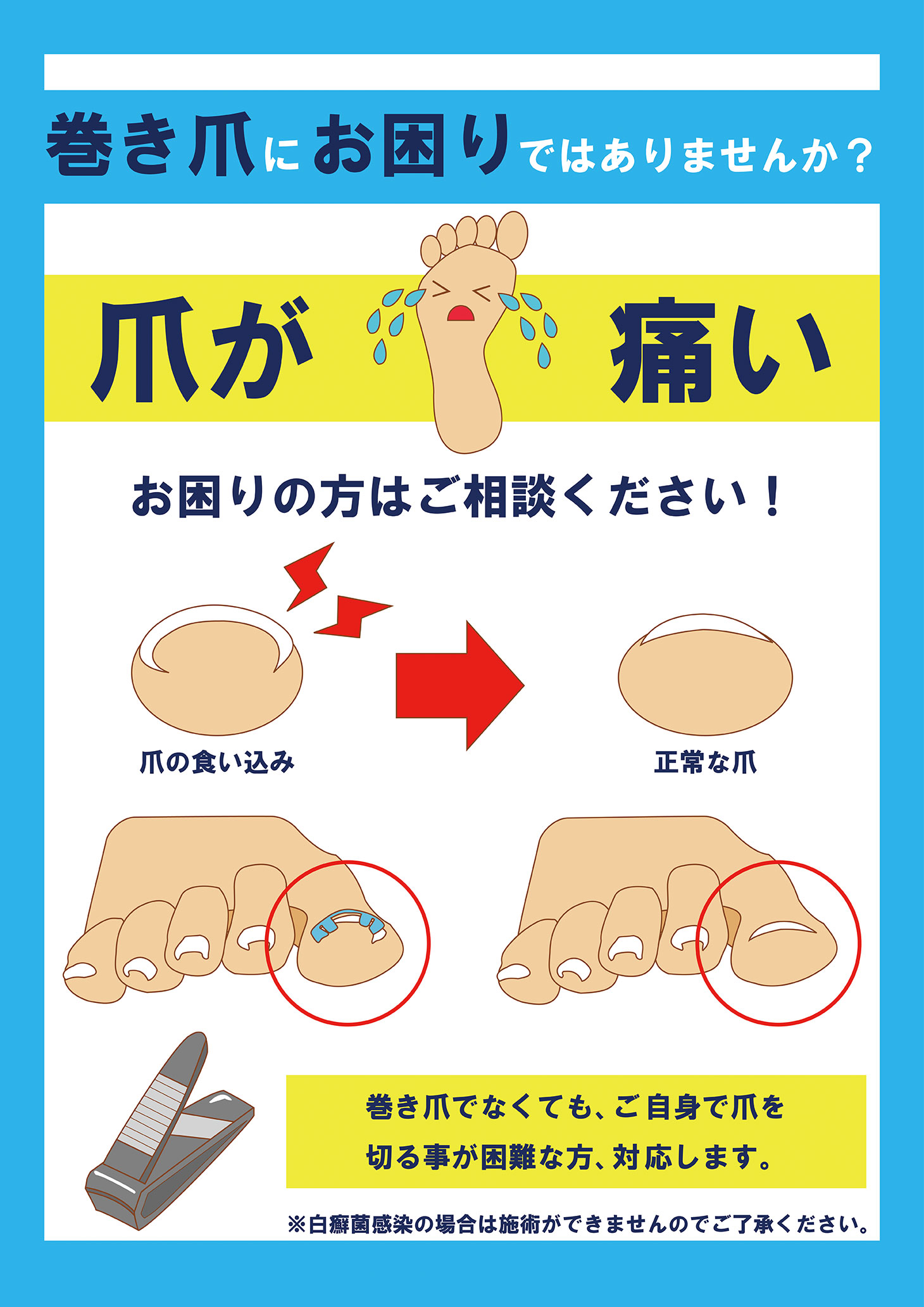 巻き爪にお困りの方に向けたポスター